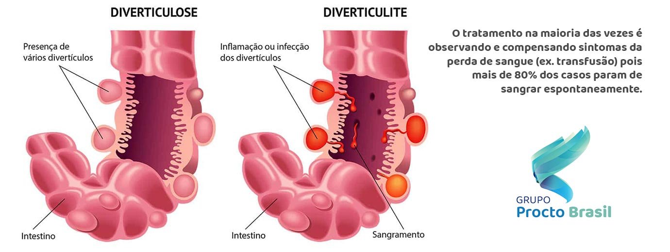 diverticulite-diverticulose-como-tratar