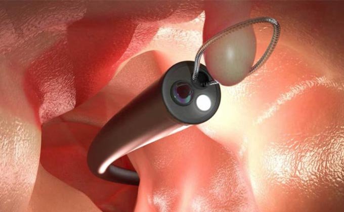 exame-de-colonoscopia-em-sao-paulo