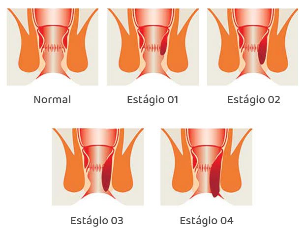 graus-da-hemorroida-como-saber