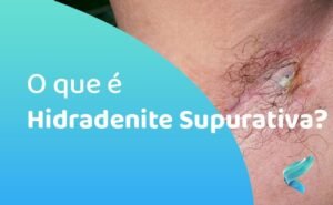 hidradenite-supurativa-como-tratar