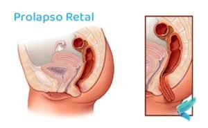 prolapso-retal-causas