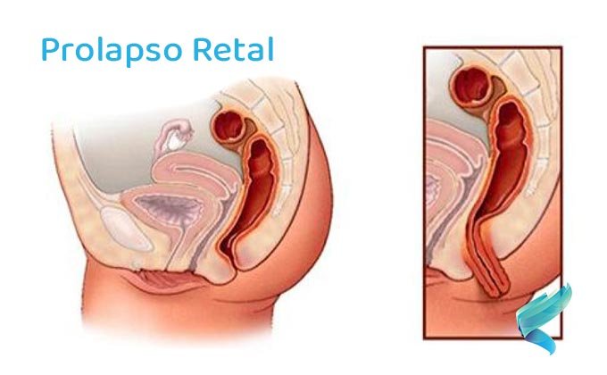 prolapso-retal-causas