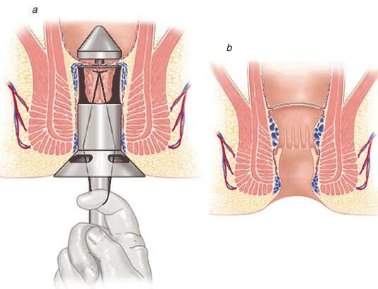 cirurgia-hemorrida-pph