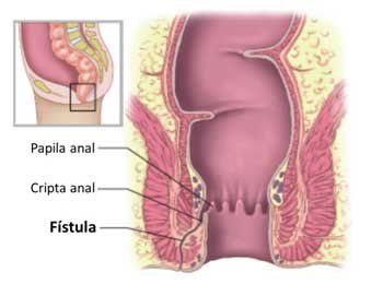 fistula-anal-o-que-é