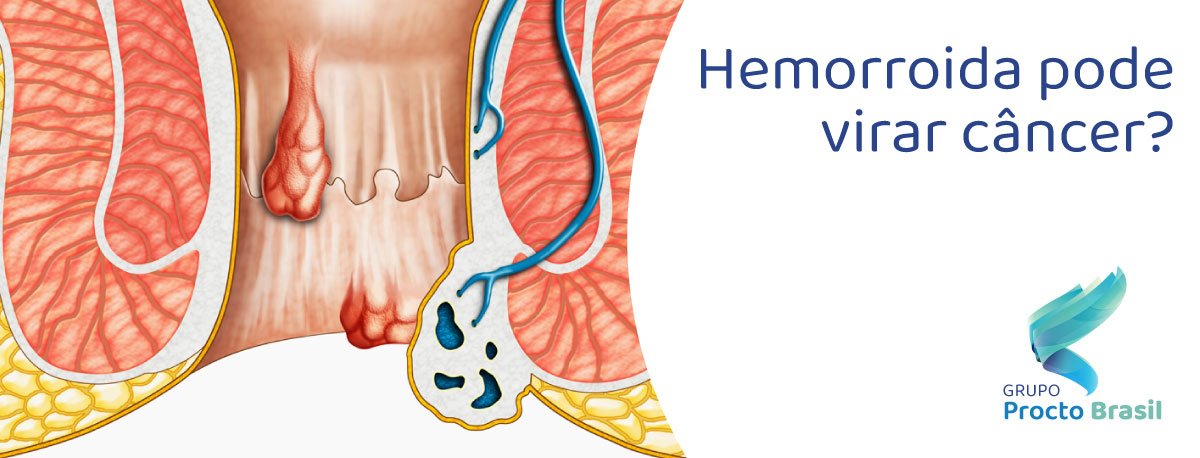 hemorroidas-cancer