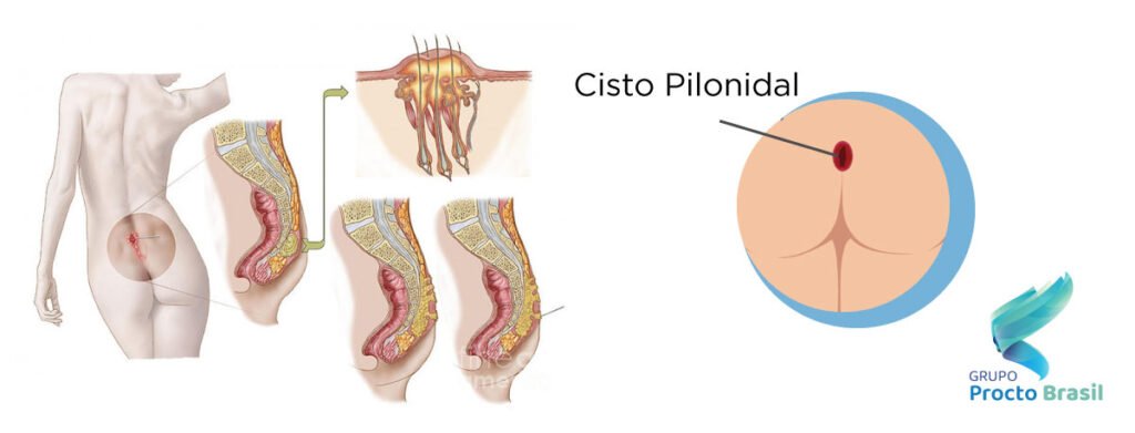 cisto-pilonidal-cirurgia