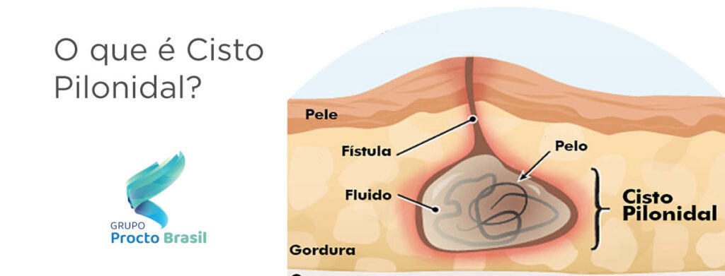 cisto-pilonidal-o-que-e